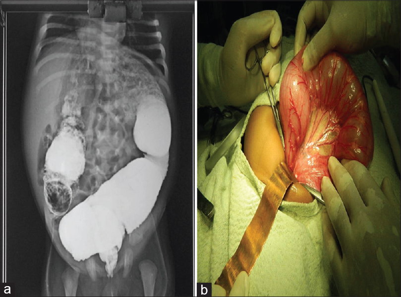 (a) Transitional zone in barium enema; (b) intraoperative dilated colon