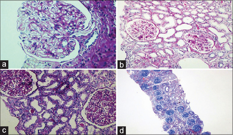 (a) Class II lupus nephritis – mesangial cell hypercellularity (periodic acid schiff ×200). (b) Class III lupus nephritis – focal and segmental glomerulonephritis (periodic acid schiff ×100). (c) Class V lupus nephritis – thickened glomerular basement membrane (periodic acid schiff ×100). (d) Class VI lupus nephritis - >90% glomerular sclerosis (Masson's trichrome stain ×100)