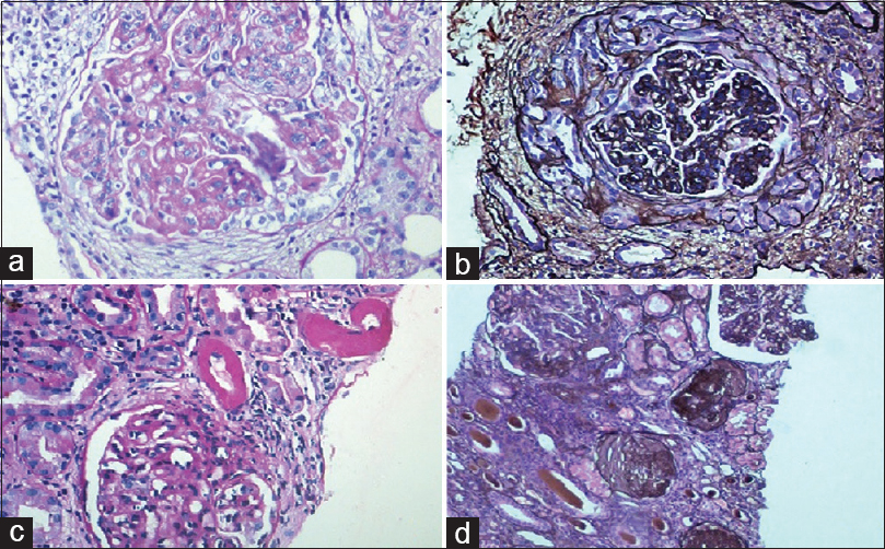 (a) Class IV lupus nephritis – endocapillary proliferation with wireloop lesions (periodic acid schiff ×200). (b) Class IV lupus nephritis – circumferential cellular crescent (Jones silver methanamine stain ×200). (c) Class IV lupus nephritis – thrombotic microangiopathy with fibrinoid necrosis of the arterioles (periodic acid schiff ×100). (d) Class IV G (A/C) lupus nephritis – two proliferative glomeruli and three sclerotic glomeruli (Jones silver methanamine stain ×100)