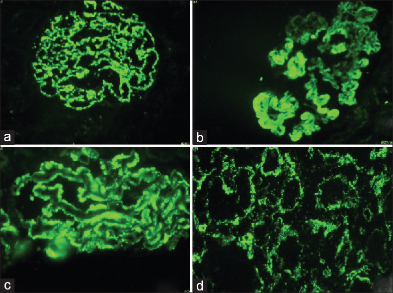 (a) Class IV lupus nephritis – mesangial and capillary loop deposits (IgG ×100). (b) Class IV lupus nephritis – subendothelial deposits and hyaline globules (IgG ×100). (c) Class V lupus nephritis – subepithelial deposits (IgG ×100). (d) Class IV lupus nephritis – tubulo-interstitial deposits (IgG ×100)