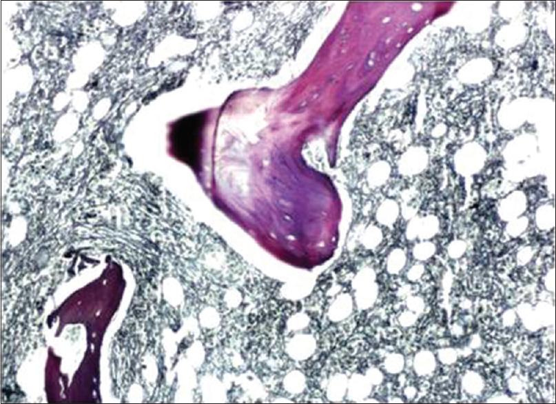 Bone marrow trephine biopsies section of myelofibrosis Grade III (Reticulin, ×100)