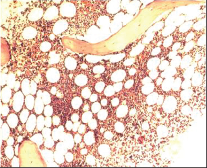 Bone marrow trephine biopsies section showing nodular and interstitial pattern (H and E, ×200)