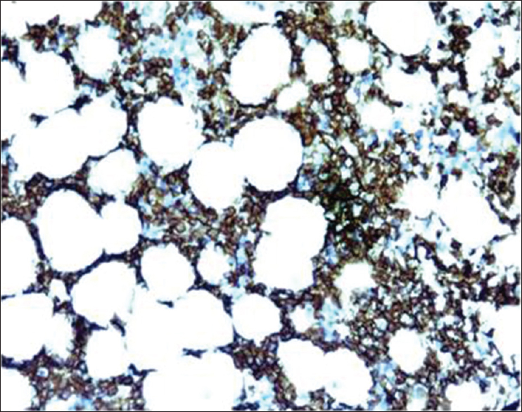 CD20 positive in Non-Hodgkin's lymphoma (IHC, ×200)