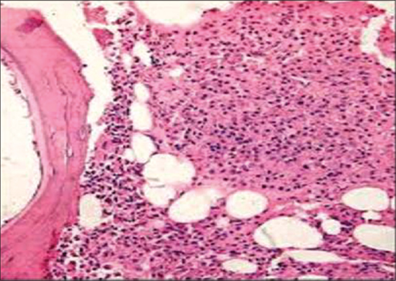 Bone marrow trephine biopsies section of plasmacytoma (H and E, ×100)