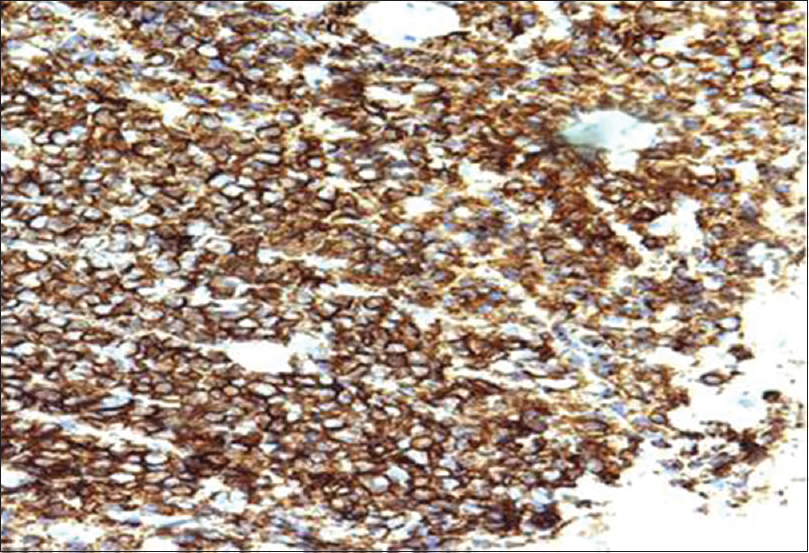 CD 138 positivity in plasmacytoma (IHC, ×200)