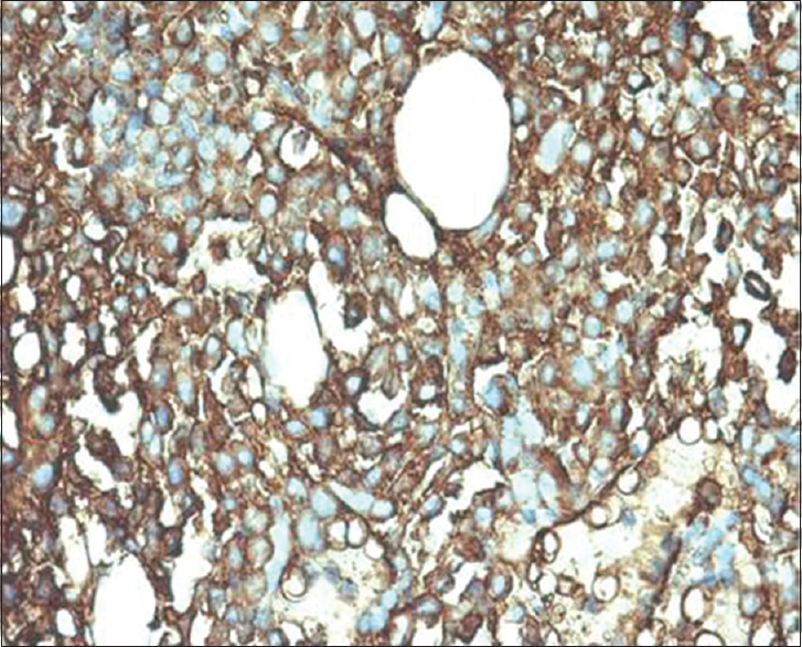 Kappa positivity in plasmacytoma (IHC, ×400)