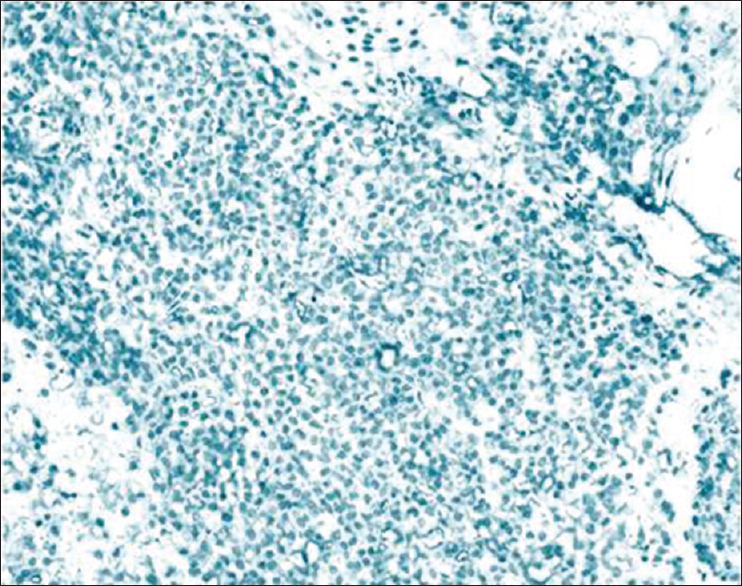 Lambda negativity in plasmacytoma (IHC, ×200)