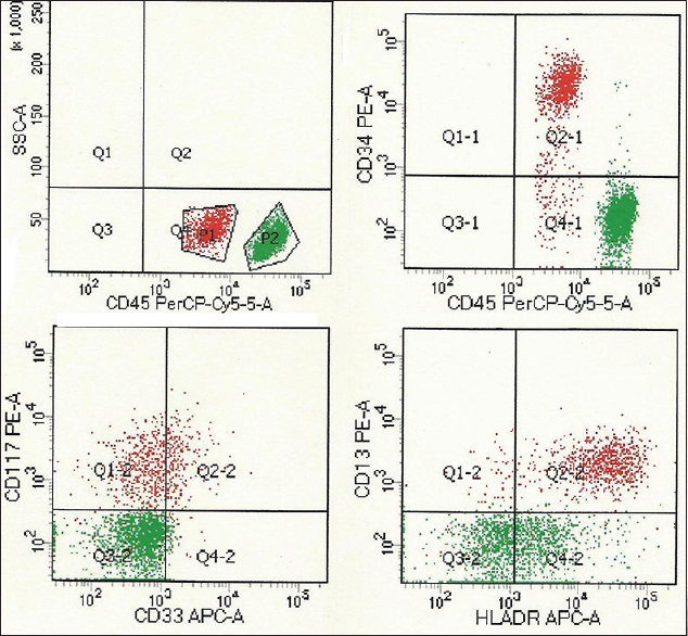 CD45 dim red cluster depicts myeloid blasts with positivity for CD34, HLADR, CD13, CD33, and CD117