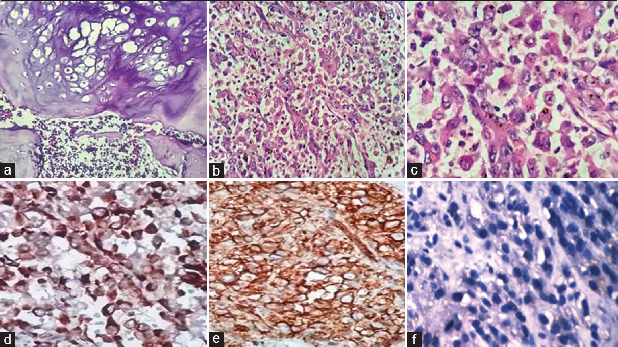 (a) Histopathology showed low-grade chondrosarcoma permeating into marrow spaces (H and E, ×100). (b) High-grade sarcomatous areas composed of tumor cells arranged in sheets and nodules with epithelioid differentiation (H and E, ×100). (c) The tumor cells had round to oval nuclei, coarse chromatin, conspicuous nucleoli, and moderate to abundant cytoplasm (H and E, ×400). (d) Pancytokeratin positivity in the tumor cells in the sarcomatous area (immunohistochemistry, ×400). (e) Vimentin positivity in the tumor cells in the sarcomatous area (immunohistochemistry, ×400). (f) Loss of integrase interactor-1 in the sarcomatous area (immunohistochemistry, ×400)