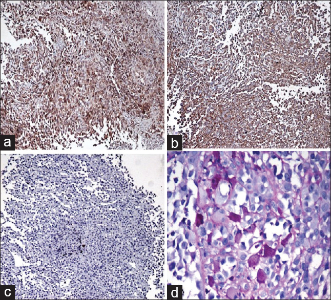 Immunohistochemical findings. (a) Diffuse cytoplasmic staining with neuron-specific enolase. (b) Cytoplasmic staining with vimentin. (c) Negative staining with cytokeratin. (d) Periodic acid–Schiff-positive, diastase-resistant crystals (PAS, ×200)