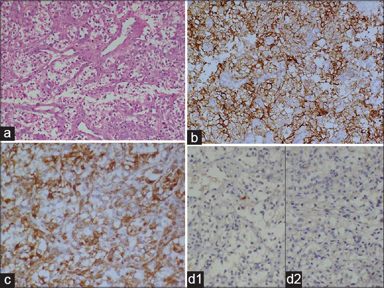 (a) Microscopic appearance of the tumor from bladder show nested growth of round to polygonal cells with amphophilic to clear cytoplasm and irregular nuclei (H and E, ×100). (b) Neoplastic cells show strong cytoplasmic positivity for CD10 (IPX, ×100), (c) Cytoplasmic vimentin positivity is strong in tumor cells (IPX, ×100), (d1) Tumor cells are negative for CK7 and (d2) CK20 (IPX, ×100)