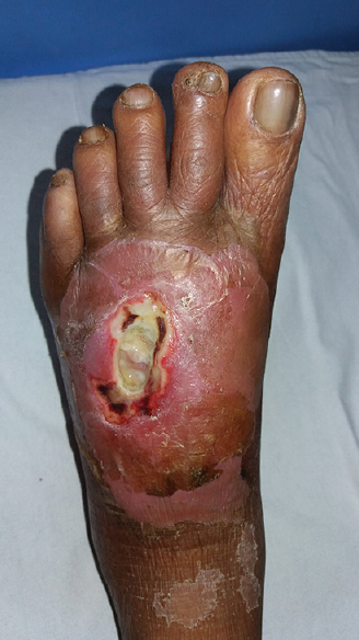 Ulcer (5 cm × 7 cm) over dorsum of the foot with necrotic base and surrounding edema