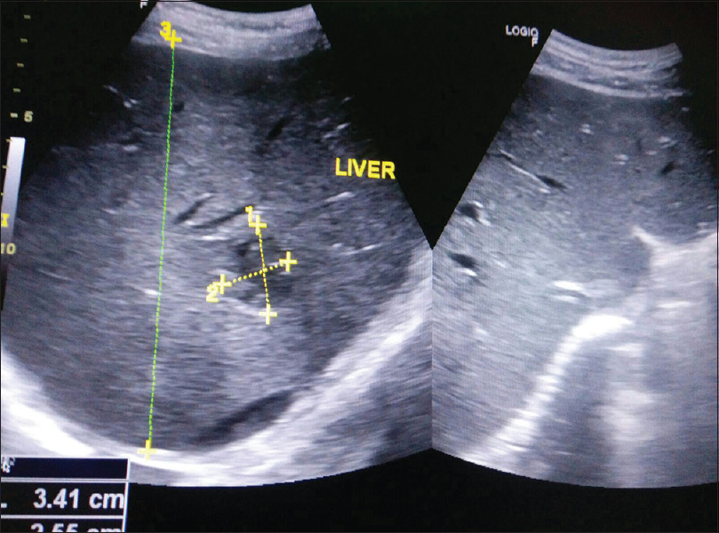 Ultrasonography of liver showing focal ill-defined hypoechoic lesion with anechoic center in the right lobe of liver