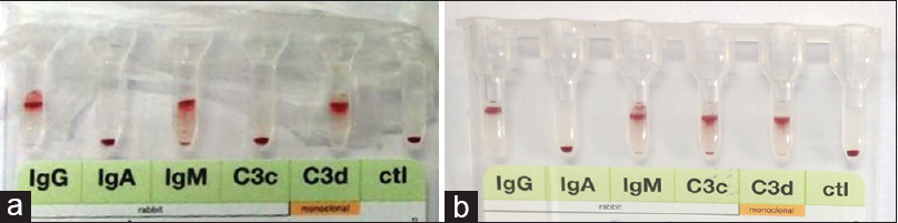 Monospecific direct antiglobulin test by column agglutination technology. (a) Case 1 – positive for IgG, IgM, and C3d (b) Case 2 – positive for IgG, IgM, C3c, and C3d