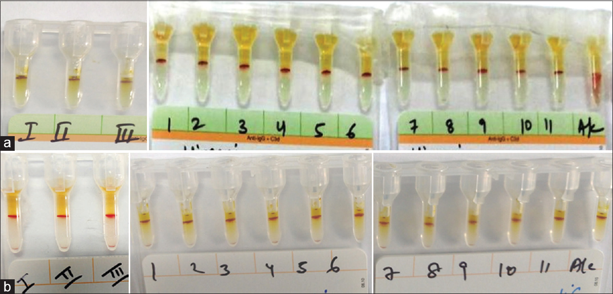 (a) Indirect antiglobulin test showing panagglutination (4+) in case 1 using antibody screening 3-cell panel and antibody identification 11-cell panel at 37°C. (b) Indirect antiglobulin test showing panagglutination (4+) in case 1 using antibody screening 3-cell panel and antibody identification 11-cell panel at 4°C