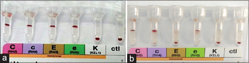 Rh/Kell antigen profile (a) case 1 positive for C, c, E and e antigens (b) case 2 positive for C, c and e antigens