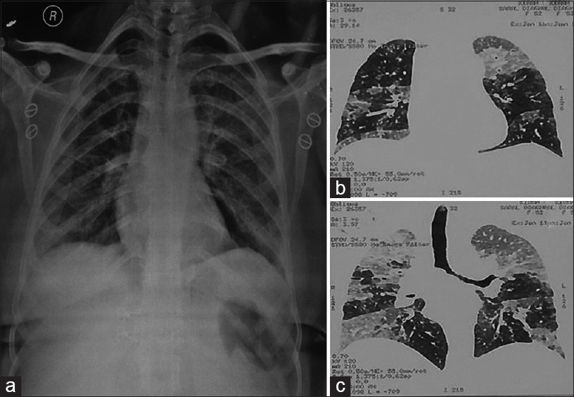(a) X-ray chest showing patchy opacity on the left midzone and right paracardiac region (pneumonitis) along with left hilar and right basal infection (alveolar proteinosis). (b and c) contrast-enhanced computed tomography chest showing bilateral ground-glass haze in lung parenchyma with interlobular septal thickening along with characteristic crazy pavement was noted on contrast-enhanced computed tomography chest suggesting a possibility of alveolar proteinosis
