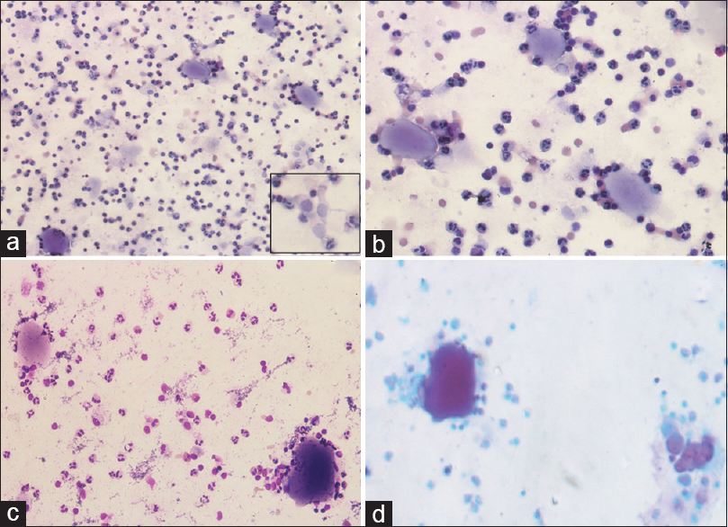 (a and b) Photomicrograph showing plaques of eosinophilic material and few groups of macrophages filled with the similar eosinophilic material. (a and b) Papanicolaou ×20 and ×40). Inset ([a] Few benign endobronchial cells). (c) Smear revealing few plaques of eosinophilic material and background showing inflammatory cells (Giemsa, ×40). (d) Eosinophilic globules showing periodic acid–Schiff positivity (×40)