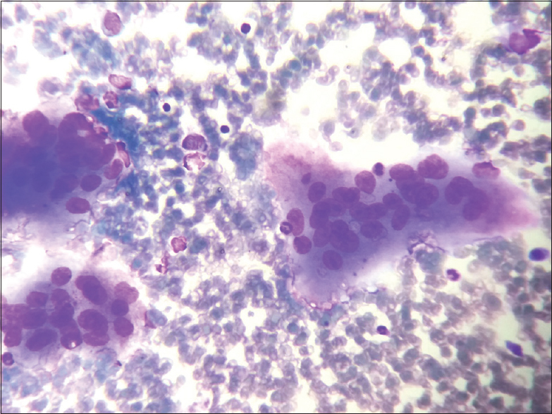 Fine-needle aspiration cytology smears showing many multinucleate giant cells (Leishman, ×400)