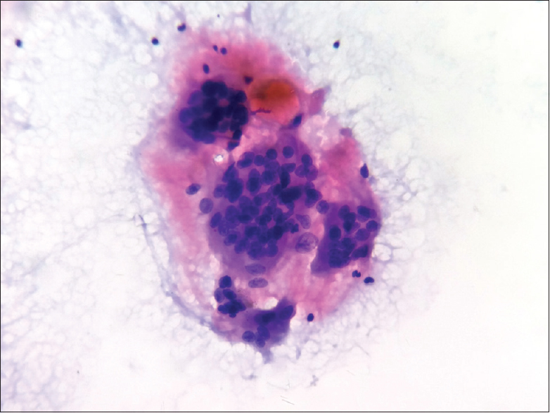 Fine-needle aspiration cytology smears showing multinucleate giant cells amidst hemorrhagic background (Papanicolaou, ×400)