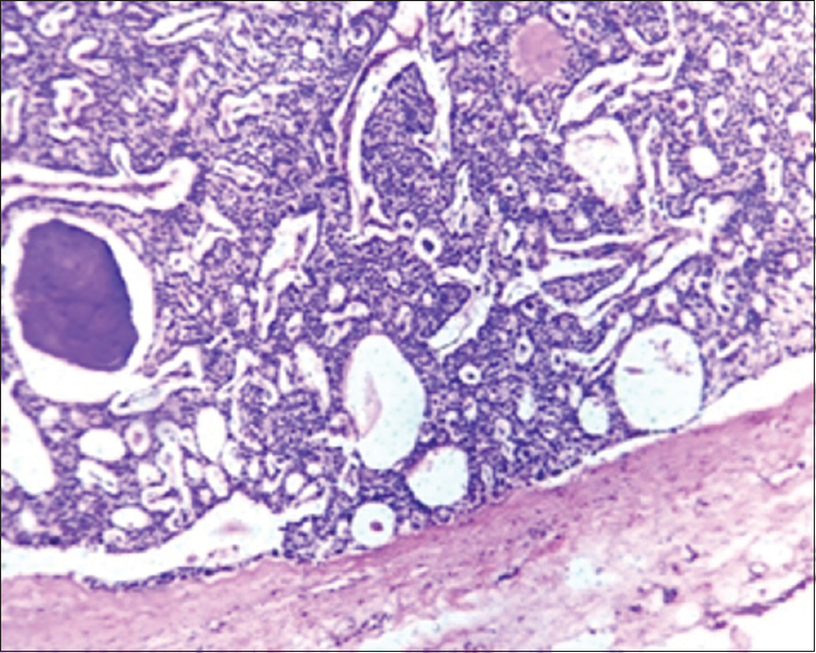 Histopathology of parathyroid adenoma (×400)