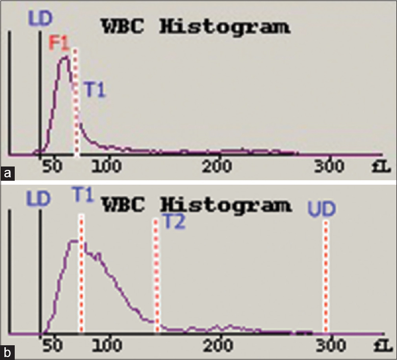 White blood cell histograms from a patient with acute viral disease (a) and a patient with acute lymphoblastic leukemia (b). The F1 curve in (a) has shifted slightly to the right with obliteration of the T1 trough, <40% preset limit. The T1 trough in (b) is obliterated at >40% of the preset limit