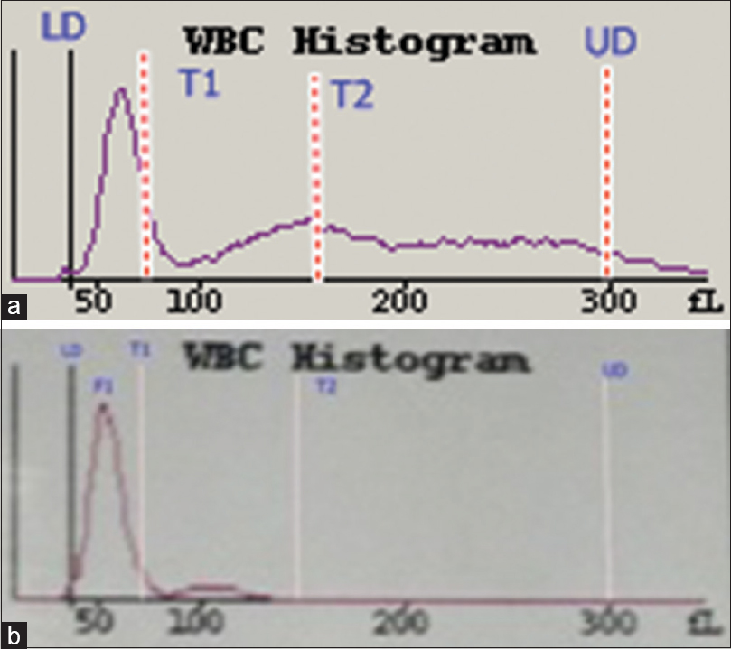 White blood cell histograms from a patient with a chronic systemic disorder (a) and a patient with chronic lymphocytic leukemia (b). The histogram in (a) is normal while the histogram in (b) shows that the F1 curve has shifted to the left