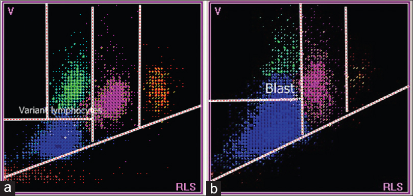 Scattergrams from a patient with acute viral disease (a) and a patient with acute lymphoblastic leukemia (b). (a) Lymphocytes are plotted in variant lymphocyte window which is slightly above and to the right of normal lymphocyte population. (b) Lymphocytes in the blast window which is well above the normal lymphocyte population