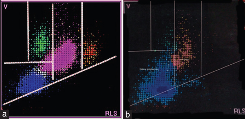 Scattergrams from a patient with a systemic disorder (a) and a patient with chronic lymphocytic leukemia (b). The scattergram in (a) is normal while the scattergram in (b) shows relatively smaller sized lymphocytes, located below the normal lymphocyte population