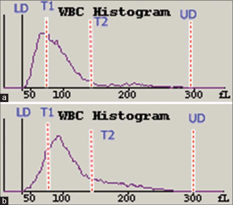 White blood cell histograms from a patient with acute lymphoblastic leukemia (a) and a patient with acute myeloid leukemia (b). A peak is seen obliterating T1 trough in (a), and a peak is seen at around 100 fl, with mild obliteration of T2 trough in (b)