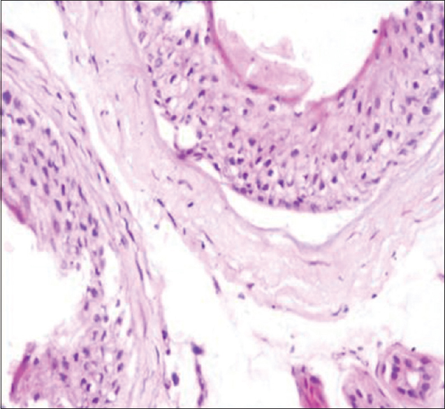 Perifollicular fibrosis seen on vertical section in a case of alopecia areata (H and E, ×400)