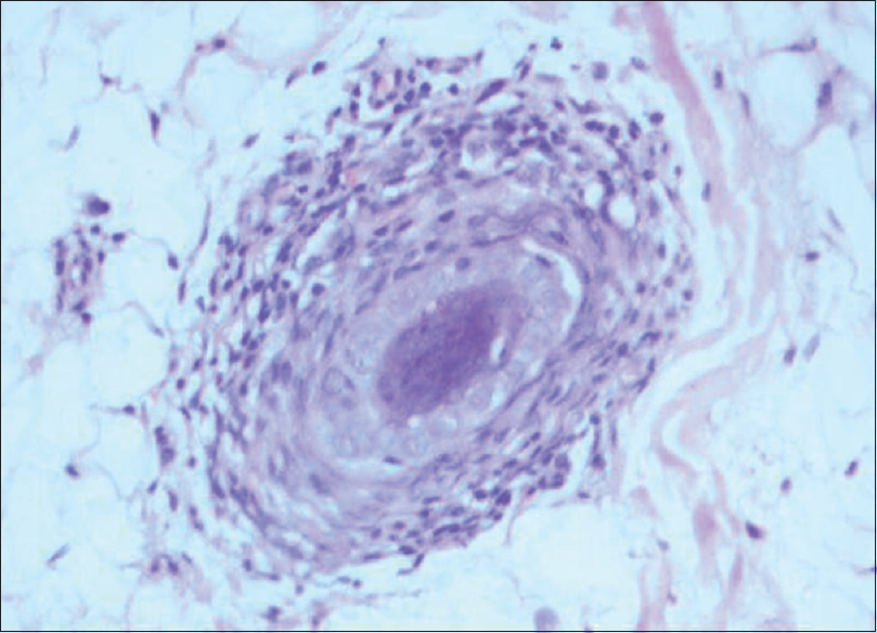 Perifollicular mononuclear cell infiltrate seen on horizontal section in a case of alopecia areata (H and E, ×400)