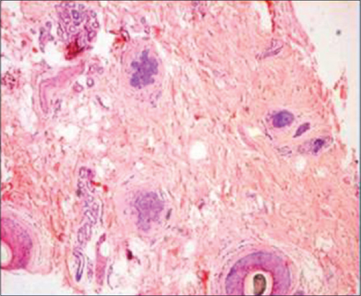 Horizontal section showing increased number of telogen in a case of telogen effluvium (H and E, ×100)