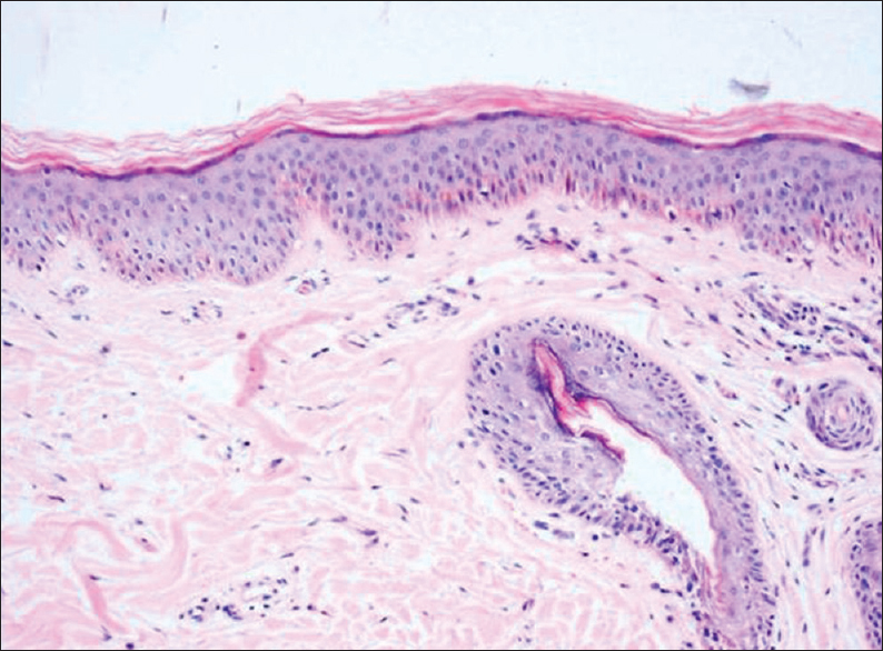 Dysmorphic hair follicle noted on horizontal section in a case of Trichotillomania (H and E, ×100)