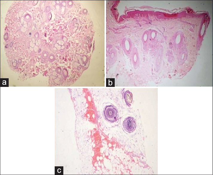 (a) An ideal horizontal section displaying the pilosebaceous units (H and E, ×40). (b) An obliquely cut scalp biopsy (H and E, ×40). (c) A scalp biopsy sectioned at the level of subcutis (H and E, ×100)