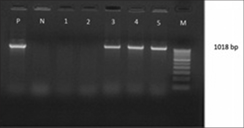Gel Doc picture showing polymerase chain reaction-amplified product of bla SHV. Lane M – 1 Kb DNA ladder, Lane 3-5 bla SHV positive amplicons (1018 bp), Lane 1-2- Isolates of Klebsiella pneumoniae without bla SHV, Lane N-Negative control, Lane P-Positive control
