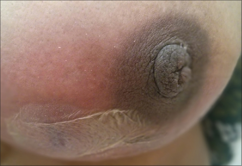 Clinical photograph showing manifestation of tuberculosis in breast in form of inflammed lump