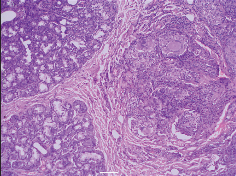 Microphotograph showing section of caseating epithelioid cell granulomas as well as adjacently lying normal breast tissue (H and E, ×40)