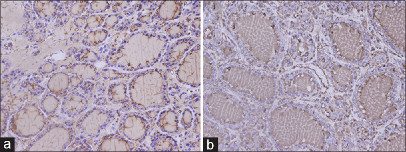 Immunohistochemistry stain of thyroid using thyroglobulin marker at magnification ×40: (a) UltraClear™ processed, (b) Xylene processed