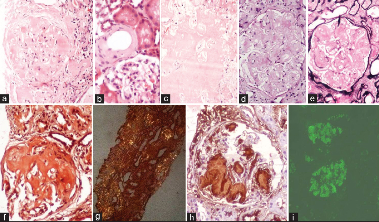 Glomerular (a), vascular (arrow) (b), and interstitial (c) amyloid deposits in H and E. These deposits are negative on periodic acid–Schiff (d) and methenamine silver-periodic acid–Schiff (e). Congo red staining shows positivity (f) with apple-green birefringence under polarizer (g). Immunohistochemistry with AA shows positivity in a case of secondary amyloidosis (h). Direct immunofluorescence showing lambda positivity in a primary amyloidosis case (i)