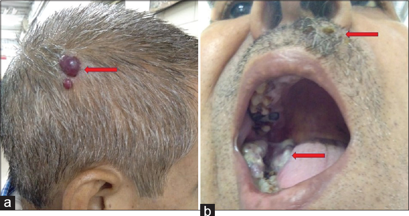 (a and b) Photographs showing multiple swellings over scalp, upper lip, and retromolar region (marked by red arrow)