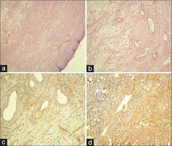 (a and b) Photomicrographs showing tumor composed of admixture of loose fibroareolar tissue with numerous variable-sized vessels and stellate reticulum cells on myxoid background (H and E, ×40). (c) Photomicrograph showing positive nuclear staining for estrogen receptors in immunohistochemistry. (d) Photomicrograph showing positive nuclear staining for vimentin in immunohistochemistry