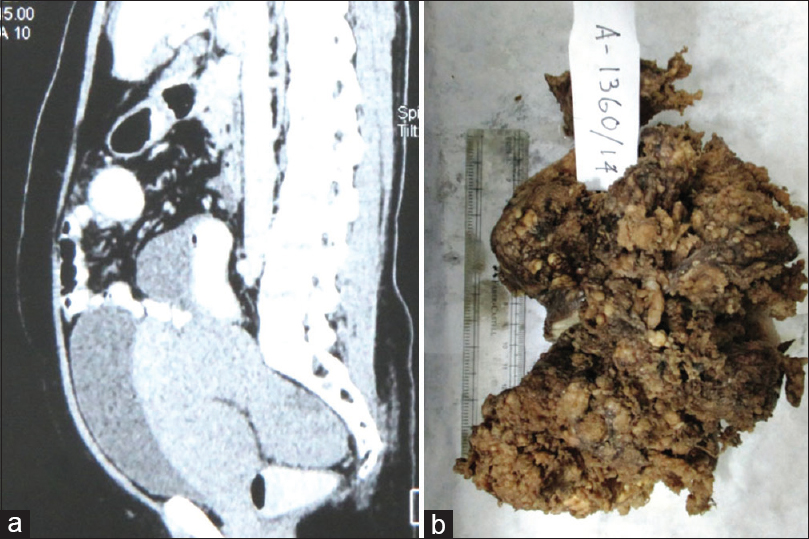 Computed tomography scan showing a intra-abdominal mass measuring 14 cm × 11 cm, without any definite site of origin. (b): Gross image of specimen of papillary mesothelioma