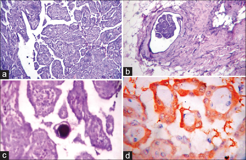 (a, b, d) Photomicrograph showing histology of mesothelioma showing broad papillae with edematous fibrous cores and lined by uniform cuboidal cells with vascular invasion (b) and psammoma bodies (d), (H and E stain, ×10 view). (c) The neoplastic cells are calretinin positive (IHC stain, ×40 view)