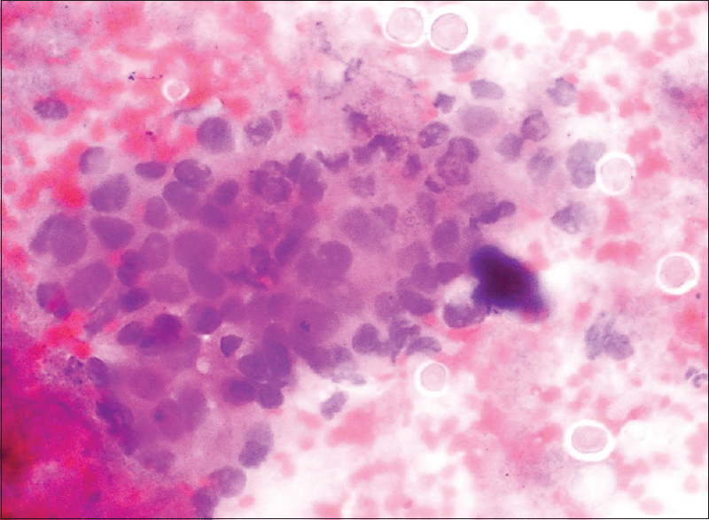 Rectal brushings showing Entamoeba cysts and clusters of malignant cells on (H and E, ×400) smear