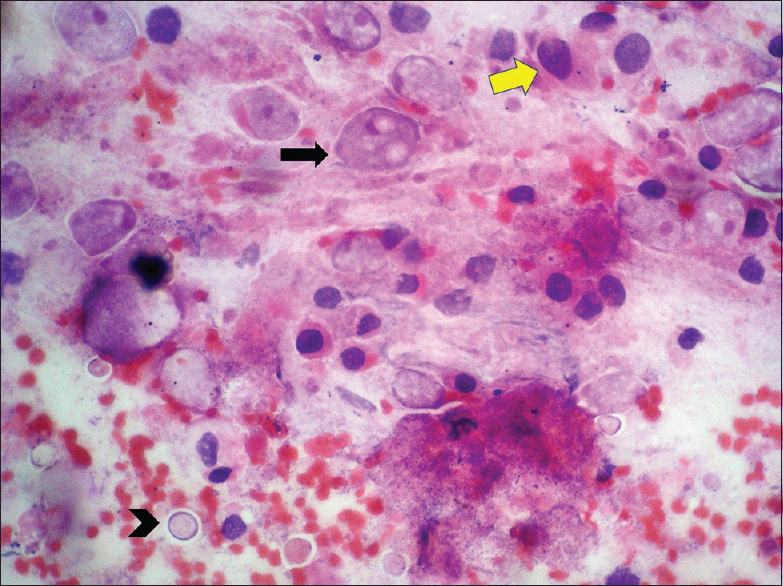 Rectal brushings showing trophozoites displaying erythrophagocytosis (arrow) and cysts (arrowhead) along with malignant cells (yellow arrow) on (H and E, ×400) smear