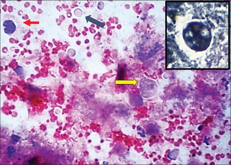 Periodic acid–Schiff stain highlighting trophozoites (yellow arrow), cysts (black arrow) and malignant cell (red arrow). Inset showing trophozoite on (PTAH, ×400)