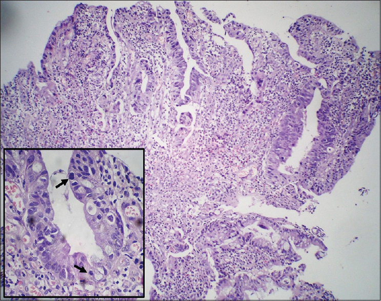 Rectal biopsy showing adenocarcinoma displaying nuclear stratification and crowding (H and E, ×40) with frequent atypical mitotic figures in inset (arrow) (×400)