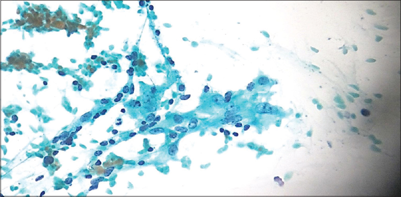 Papanicolaou-stained smear minimal infiltration of thyroid follicles by lymphocytes, ×40