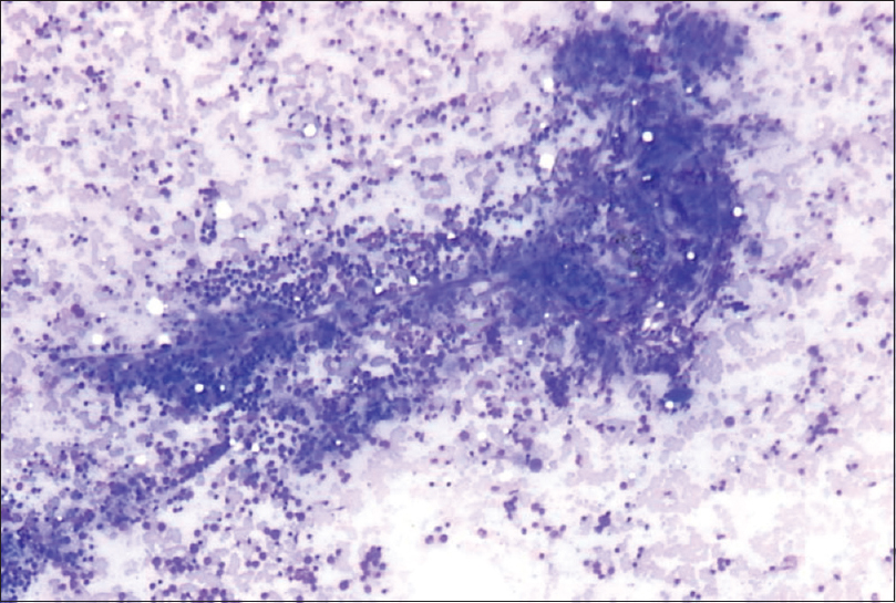 Giemsa-stained smear showing dense infiltration of thyroid follicles by lymphocytes, ×10